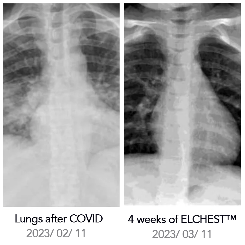 ELCHEST™ Herbal Lung Cleanse Repair Nasal Spray - flowerence